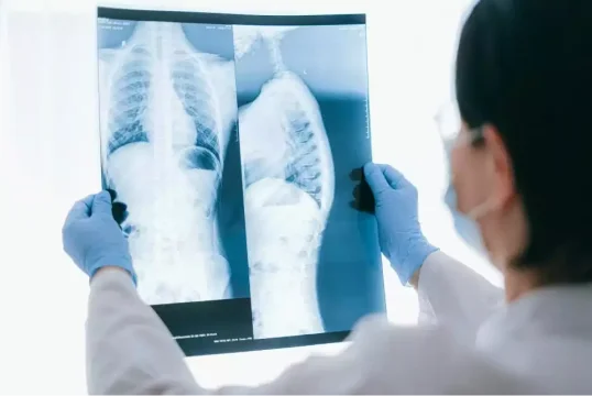 Spinal Cord Accident Attorney
