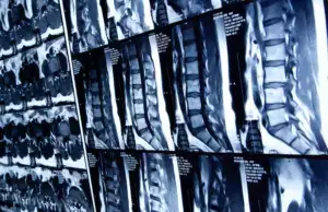 A series of spinal cord x rays.