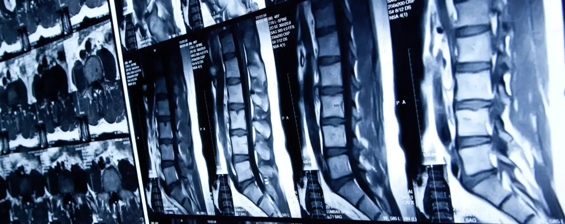 A series of spinal cord x rays. 