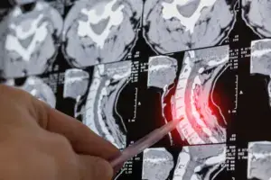 A spinal cord x-ray.